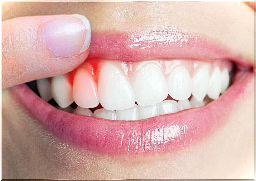 5 Remedies for Treating Gingivitis