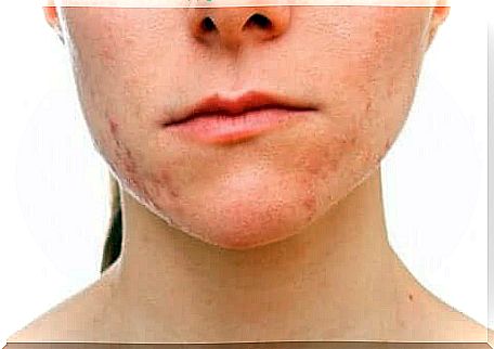 Acne Conglobata: Causes and Symptoms