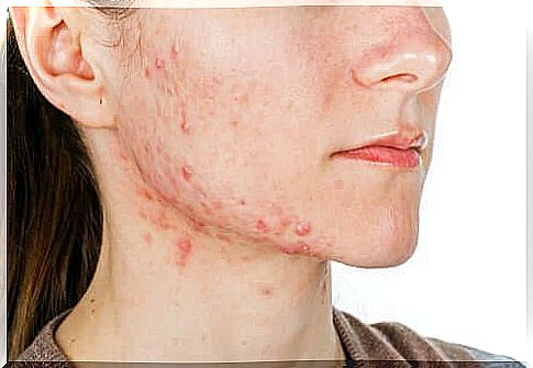 A young woman with acne