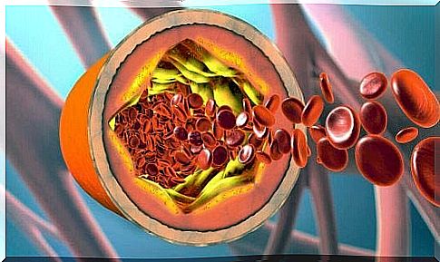 Causes of arteriosclerosis