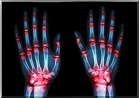 Hands with osteoarthritis