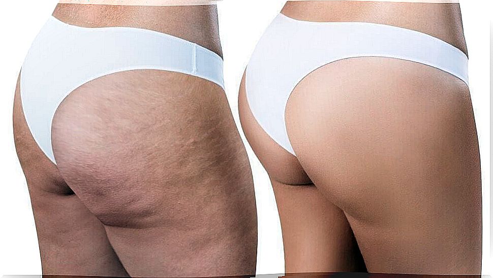 Cellulite buttocks and smooth buttocks in a white slip