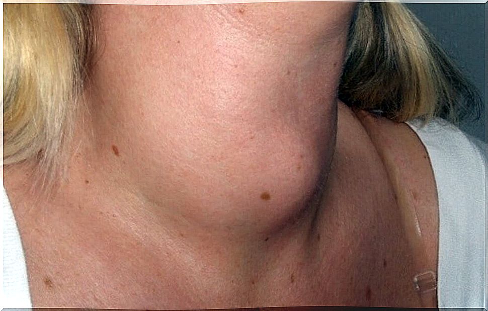 Early Signs of Throat Cancer: Swelling in the Neck