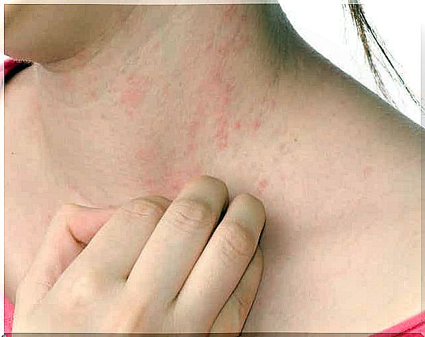 Skin with eczema