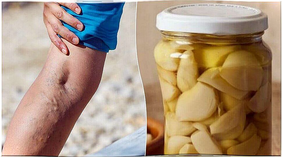 Home remedy with orange to treat varicose veins