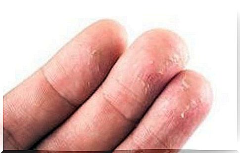 How to get rid of eczema naturally