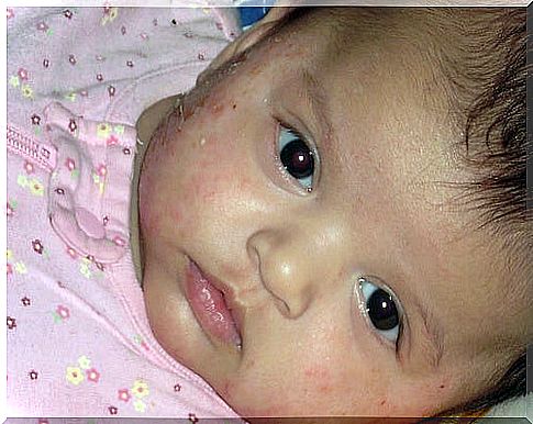 Eczema is common in children