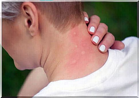 Learn all about mosquito bites here