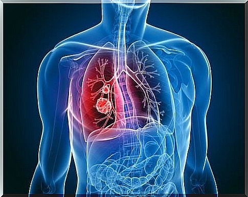 Chemotherapy for lung cancer