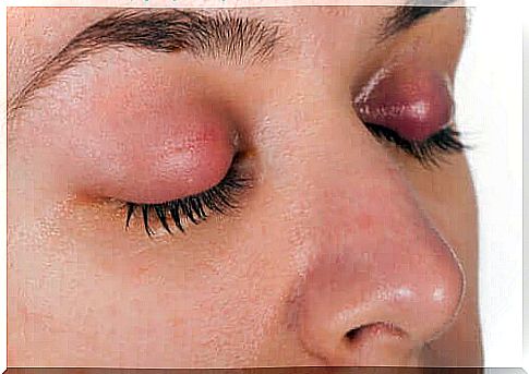 Symptoms and treatment of an eyelid infection