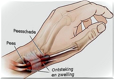 Tendonitis in the hands and feet