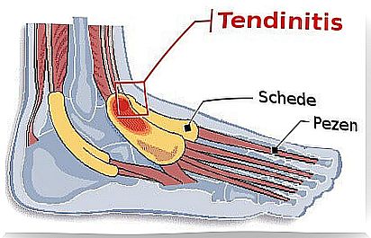 Tendonitis in the foot