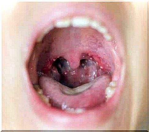 Throat with white spots