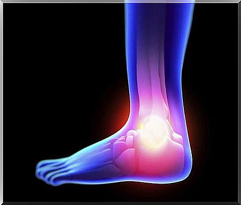 Treat the symptoms of sprain naturally