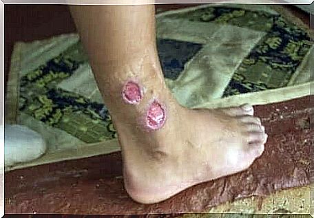 A leg with cutaneous leishmaniasis