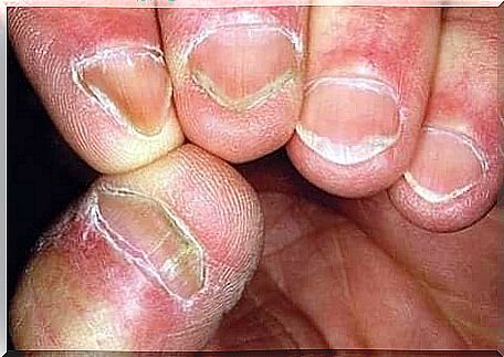 Nails of someone with Hallopeau's disease