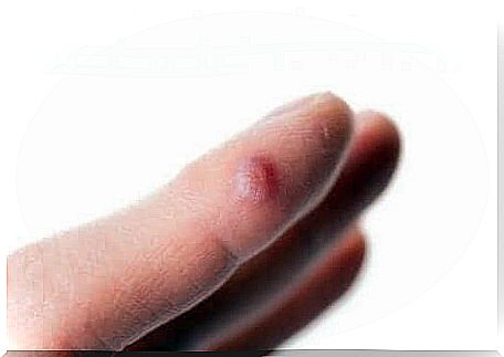 A finger with a blister on it